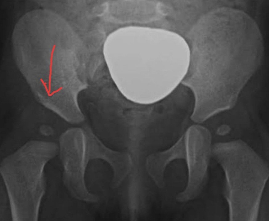 Cadera con displasia acetabular
