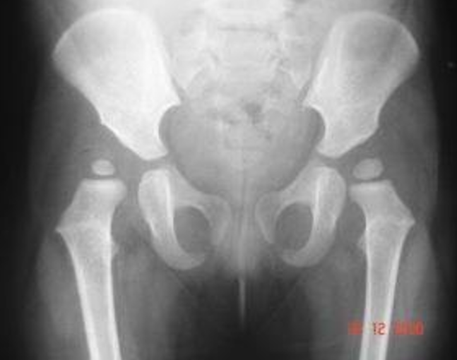 Cadera con displasia acetabular