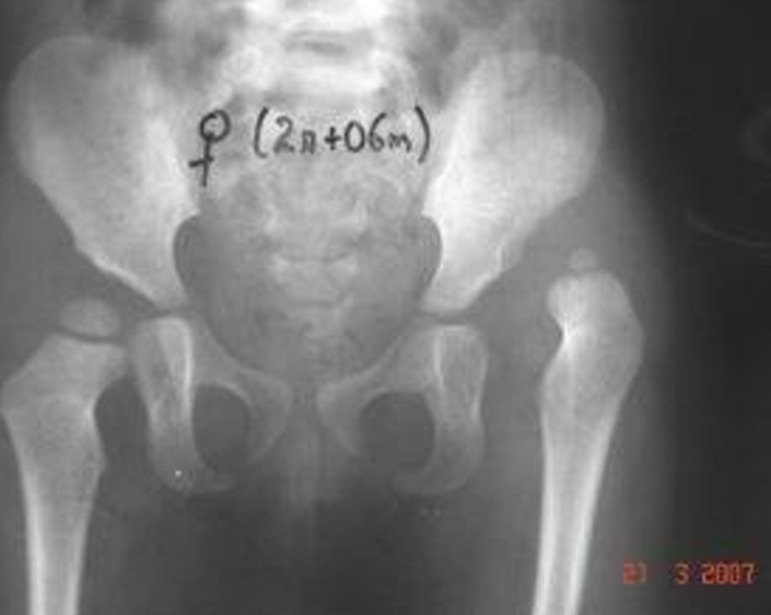 Displasia acetabular con cadera luxada