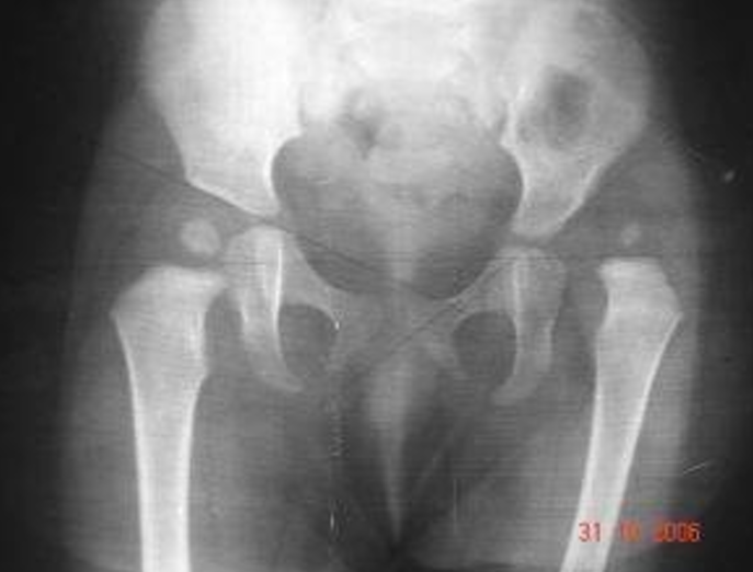 Displasia acetabular con cadera sub-luxada